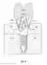 Fig. 10 - Methods and devices for countering gingival effects in dental restoration