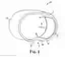 Fig. 03 - Cuff of an artificial urinary sphincter system