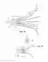 Fig. 08 - Embolus blood clot filter delivery system