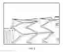Fig. 04 - Graft dimpling to improve crimp profile and reduce delivery forces