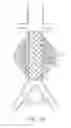 Fig. 02 - Devices and methods for treatment of abdominal aortic aneurysm