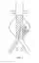 Fig. 07 - Devices and methods for treatment of abdominal aortic aneurysm