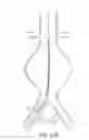 Fig. 24 - Devices and methods for treatment of abdominal aortic aneurysm