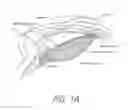 Fig. 02 - Accommodating intraocular lenses