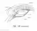 Fig. 03 - Accommodating intraocular lenses