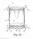 Fig. 03 - Replacement prosthetic heart valve, system and method of implant