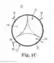 Fig. 04 - Replacement prosthetic heart valve, system and method of implant
