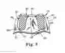 Fig. 08 - Replacement prosthetic heart valve, system and method of implant