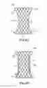 Fig. 09 - Replacement prosthetic heart valve, system and method of implant