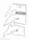 Fig. 01 - Artificial intervertebral disc implant device