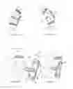 Fig. 04 - Artificial intervertebral disc implant device