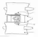 Fig. 01 - Apparatus and method for anterior intervertebral spinal fixation and fusion
