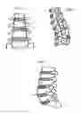 Fig. 02 - Apparatus and method for anterior intervertebral spinal fixation and fusion