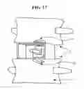 Fig. 16 - Apparatus and method for anterior intervertebral spinal fixation and fusion