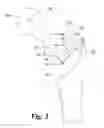 Fig. 03 - Length/offset reproducing device for total hip arthroplasty