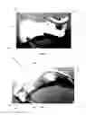 Fig. 02 - Cervical collar