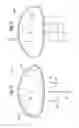 Fig. 04 - Glaucoma drainage shunts and methods of use