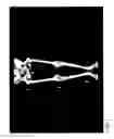 Fig. 02 - Method for Treating and Correcting Gait Related Joint Dysfunctions