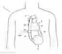 Fig. 01 - Blood clot removal device, system, and method