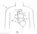 Fig. 02 - Blood clot removal device, system, and method