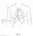 Fig. 08 - Blood clot removal device, system, and method