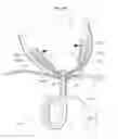 Fig. 49 - Heart help device, system, and method