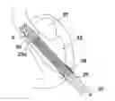 Fig. 01 - Implantable pump system, as well as a mehod for bringing a pump system to a location application