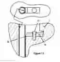 Fig. 11 - HEMODIALYSIS ACCESS SYSTEM