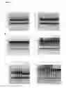Fig. 05 - Nebultzation of immunoglobulin