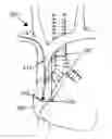 Fig. 01 - Method and system of utilizing ECG signal for central venous catheter tip positioning