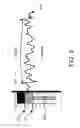 Fig. 09 - Method and system of utilizing ECG signal for central venous catheter tip positioning