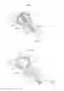Fig. 04 - Hip joint device and method
