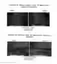 Fig. 04 - METHOD OF TREATING KELOIDS OR HYPERTROPHIC SCARS USING ANTISENSE COMPOUNDS TARGETING CONNECTIVE TISSUE GROWTH FACTOR (CTGF)