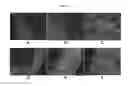 Fig. 06 - ENGINEERED THREE-DIMENSIONAL BREAST TISSUE, ADIPOSE TISSUE, AND TUMOR DISEASE MODEL