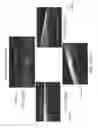 Fig. 63 - Conformable therapeutic shield for vision and pain
