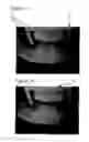 Fig. 02 - Inspection video radiation filter
