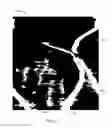 Fig. 25 - Guidewire detection systems, methods, and apparatuses
