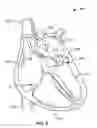 Fig. 06 - Apparatus and methods for facilitating treatment of tissue via improved delivery of energy based and non-energy based modalities