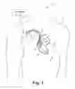 Fig. 02 - Absolute intrathoracic impedance based scheme to stratify patients for risk of a heart failure event