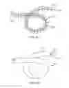 Fig. 35 - Lung volume reduction devices, methods, and systems