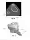 Fig. 05 - Skin-Referencing Surgical Guides