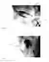 Fig. 12 - INTRAVASCULAR TISSUE DISRUPTION