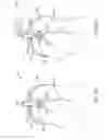 Fig. 04 - Methods and devices for removing obstructing material from the human body