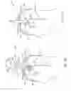 Fig. 05 - Methods and devices for removing obstructing material from the human body