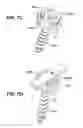 Fig. 09 - Low profile spinal tethering devices