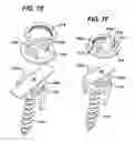 Fig. 10 - Low profile spinal tethering devices