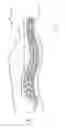 Fig. 02 - ODONTOID BULLET