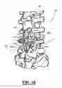 Fig. 09 - Adjustable spine distraction implant