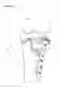 Fig. 04 - Fixing tool for open-wedge high tibial osteotomy