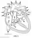 Fig. 07 - Real-time lesion formation assessment